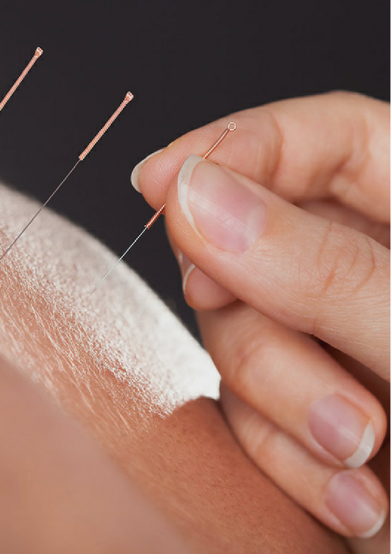 What does acupuncture treatment feel like?